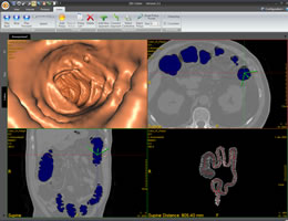 Full-featured virtual colonoscopy