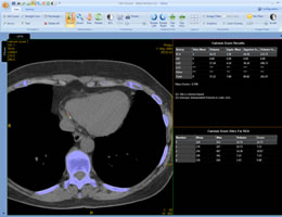 Automatic calcium scoring