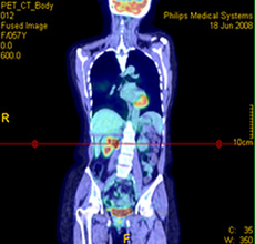 Brain Perfusion analysis