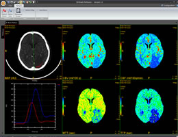 3Di Brain Perfusion